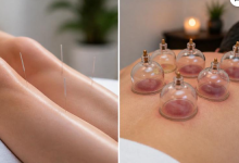 4 Differences Between TCM Weight Loss and Cupping Slimming